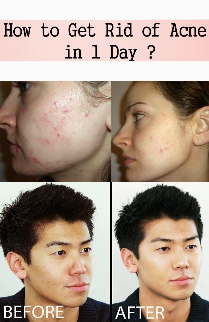 How to Get Rid of Acne in 1 Day? | Nature Is The Answ