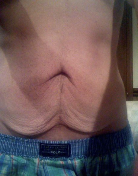 20 ways to tighten skin during massive weight-loss (over 25 lbs of loss)