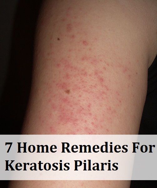 7 Home Remedies For Keratosis Pilaris