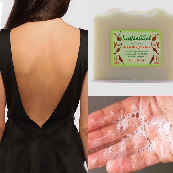 Back acne pimples treatment. One reason that your acne returns may be attributed to your skin having been suppressed by the chemical agents in the soap and then having a reaction against it. This can lead to more acne breakouts. This soap soothe red infla